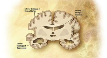 Investigación de la enfermedad de Alzheimer