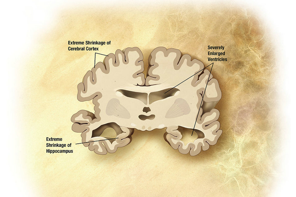 Pesquisa da doença de Alzheimer